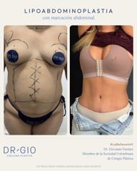 Lipoabdominoplastia con marcación abdominal