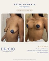 Pexia mamaria con implantes (cierre en T invertida)