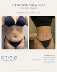 Lipoescultura 360 con plasma de argón