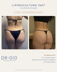 Lipoescultura 360 con plasma de argón + lipotransferencia glútea