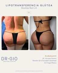 Lipotransferencia glútea (BBL)