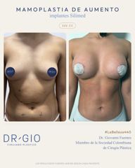 Mamoplastia de aumento 325 cc (implantes Silimed)