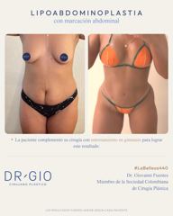 Lipoabdominoplastia con marcación (complementada con gimnasio)
