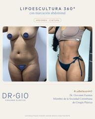 Lipoescultura 360 con marcación abdominal
