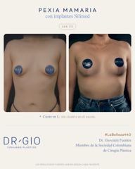 Pexia mamaria en L con implantes 280 cc