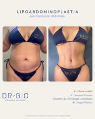 Lipoabdominoplastia con marcación abdominal