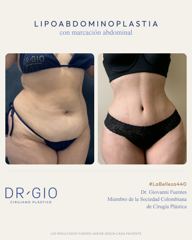 Lipoabdominoplastia con marcación abdominal