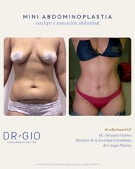 Miniabdominoplastia con lipo y marcación abdominal